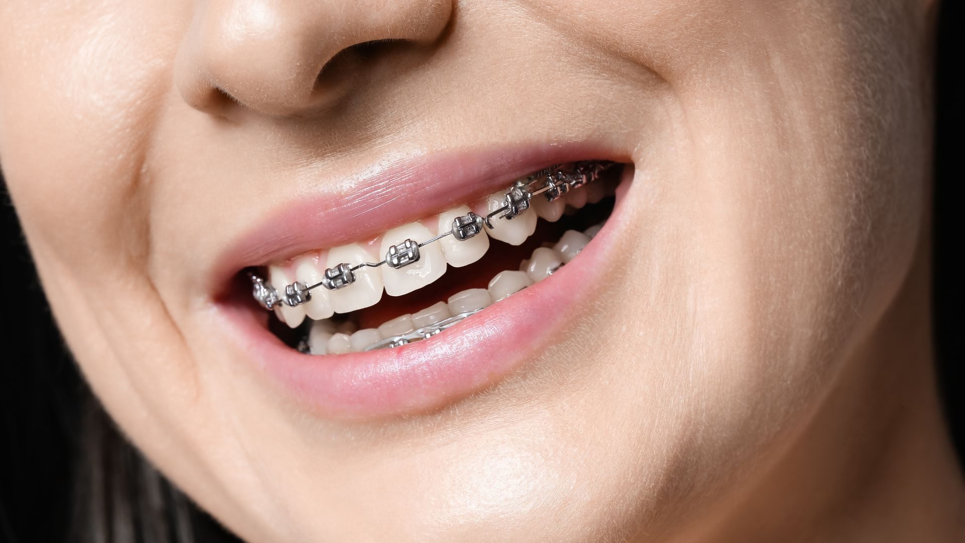 Orthodontic Braces